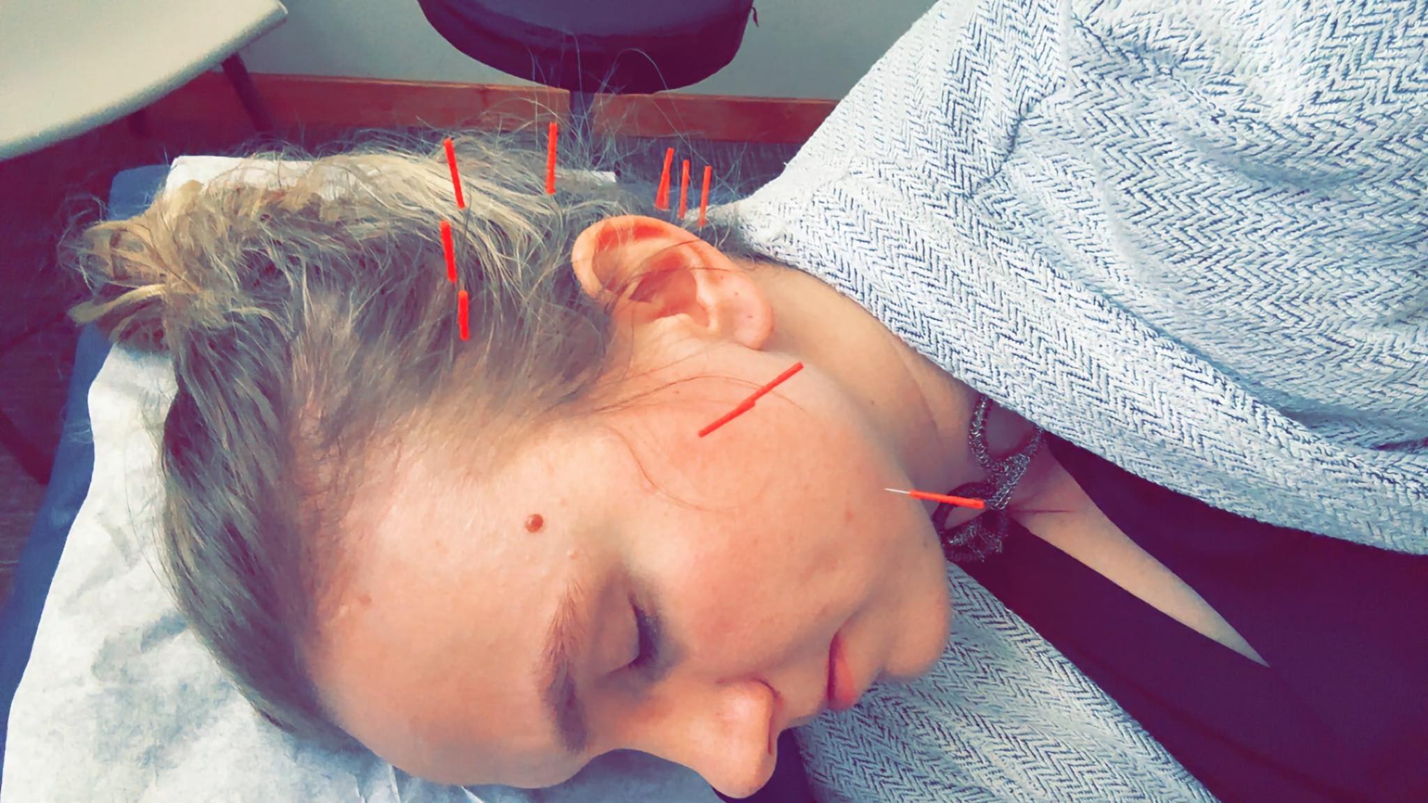 Acupuncture treatment